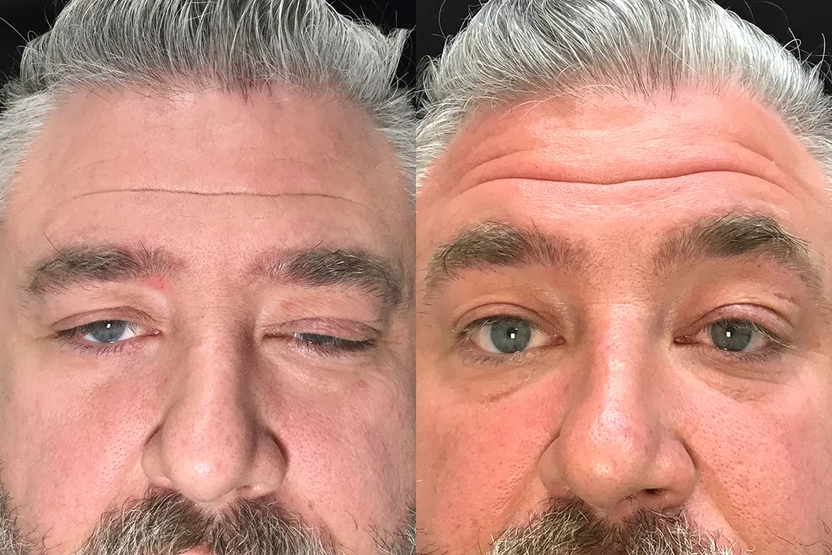 Front Levator repair before and after photo by Kristin J Tarbet MD