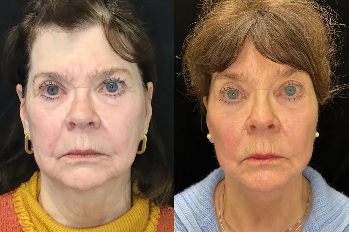 Front View Facelift:Endoscopic Browlift before and after photo by Kristin J Tarbet MD