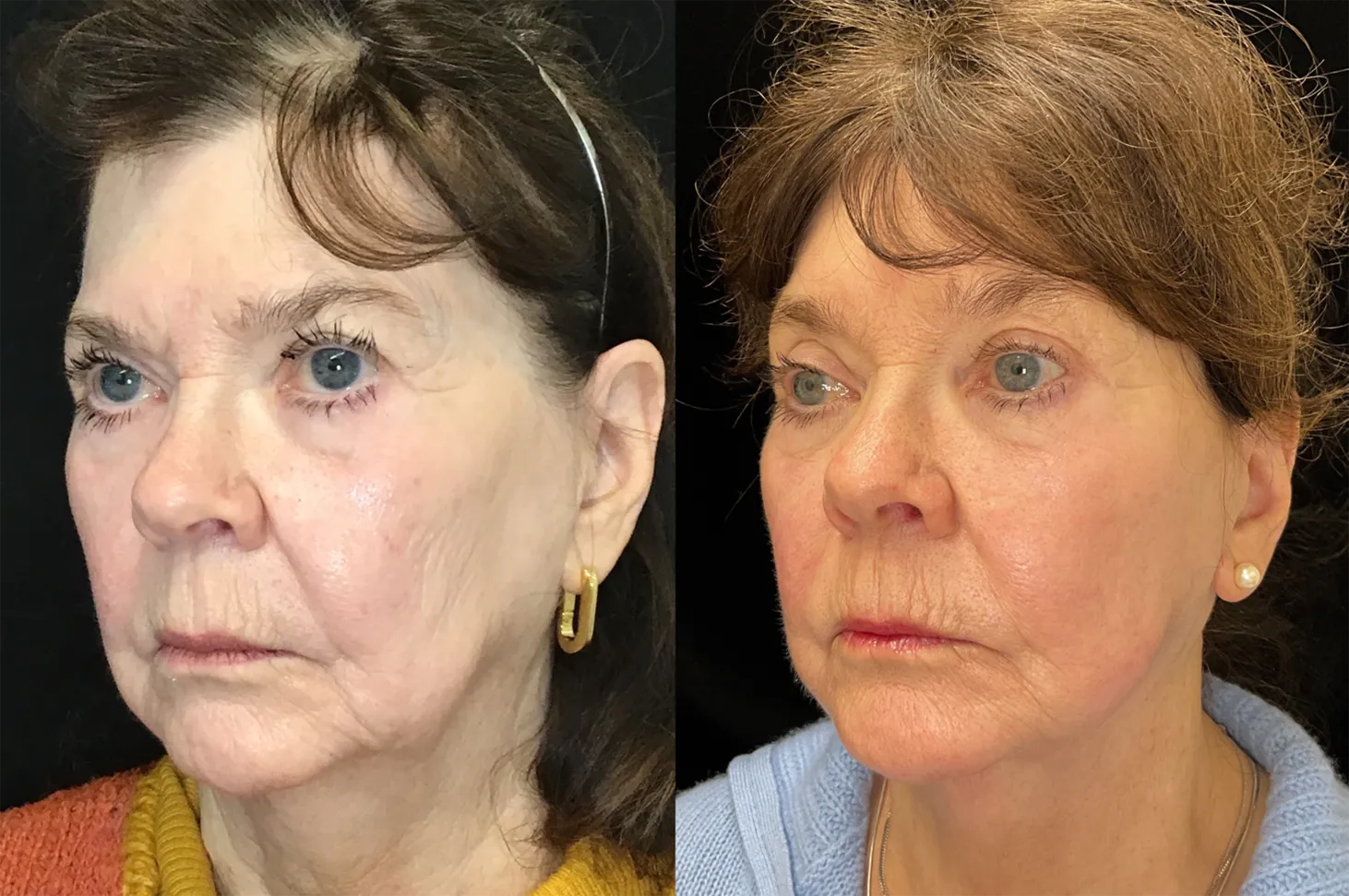 Left Oblique View Facelift:Endoscopic Browlift before and after photo by Kristin J Tarbet MD