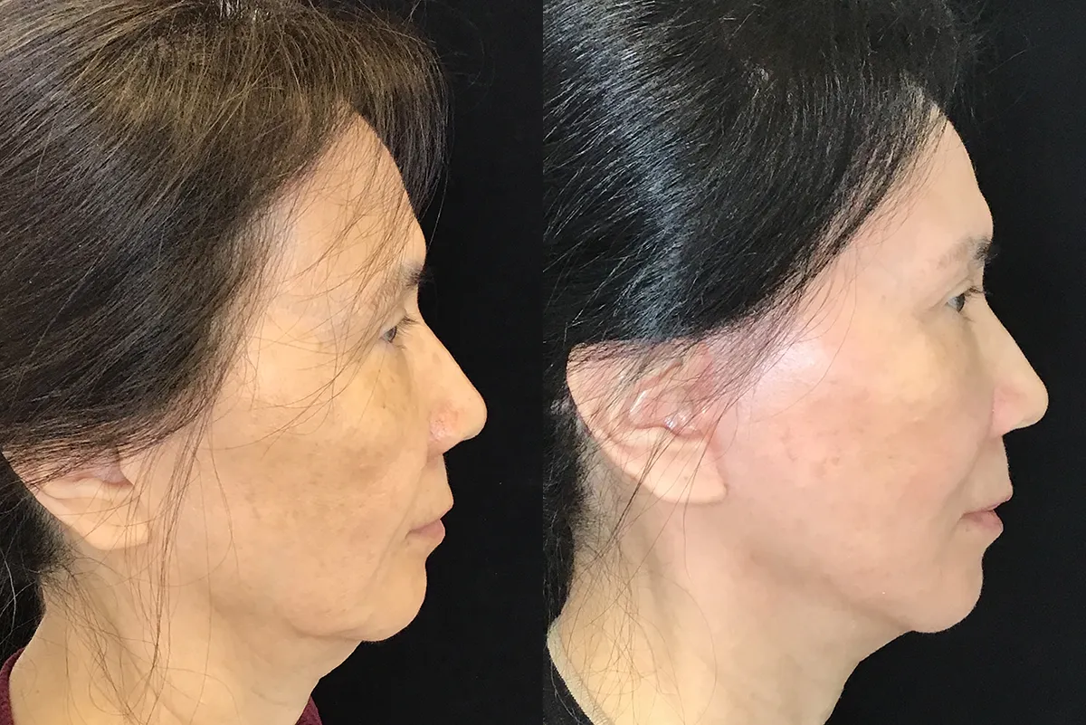 Left Side View Facelift before and after photo by Kristin J Tarbet MD
