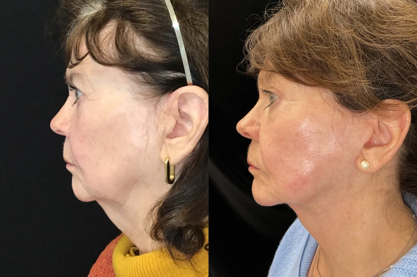 Left Side View Facelift:Endoscopic Browlift before and after photo by Kristin J Tarbet MD