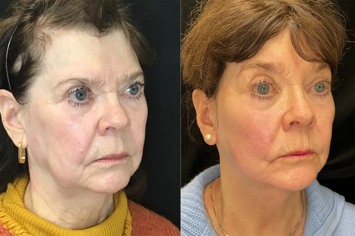 Right Oblique View Facelift:Endoscopic Browlift before and after photo by Kristin J Tarbet MD