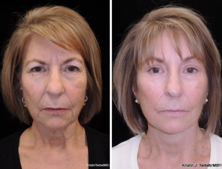 Front Endoscopic Browlift with Upper Blepharoplasty before and after photo by Kristin J Tarbet MD