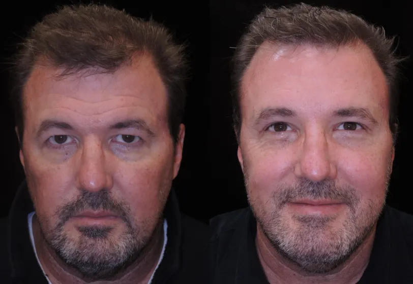 Front Upper Blepharoplasty, Endoscopic Browlift before and after photo by Kristin J Tarbet MD