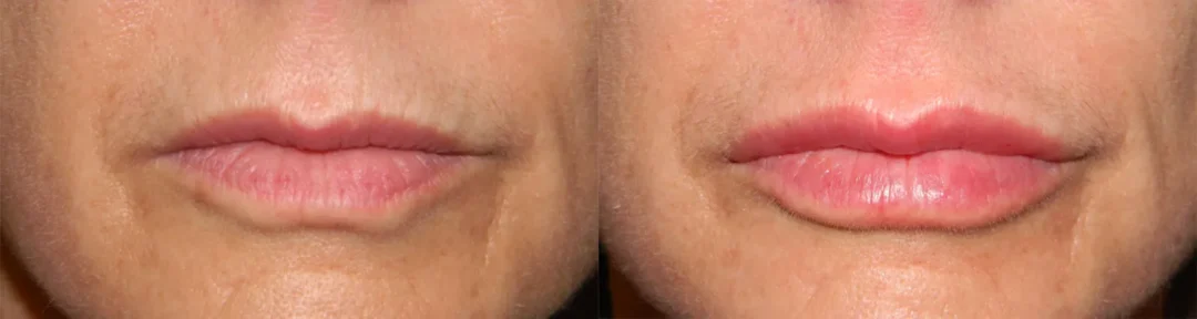 Front View Lip Filler before and after photo by Kristin J Tarbet MD