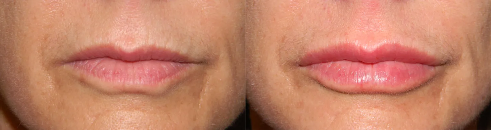 Front View Lip Filler before and after photo by Kristin J Tarbet MD