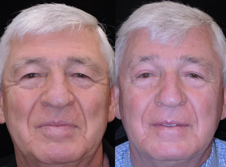 Front View Upper Blepharoplasty & Endoscopic Browlift before and after photo by Kristin J Tarbet MD