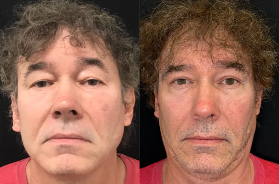 Front View Upper Blepharoplasty before and after photo by Kristin J Tarbet MD