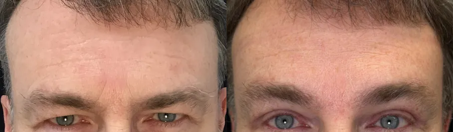 Front View Upper Bleph with Endoscopic Browlift before and after photo by Kristin J Tarbet MD