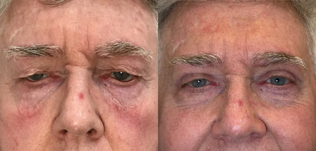 Front View upper blepharoplasty with ectropion before and after photo by Kristin J Tarbet MD