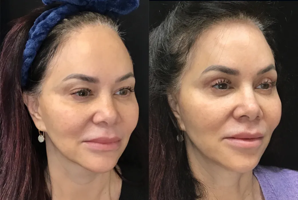 Right Oblique View surgical lip lift before and after photo by Kristin J Tarbet MD