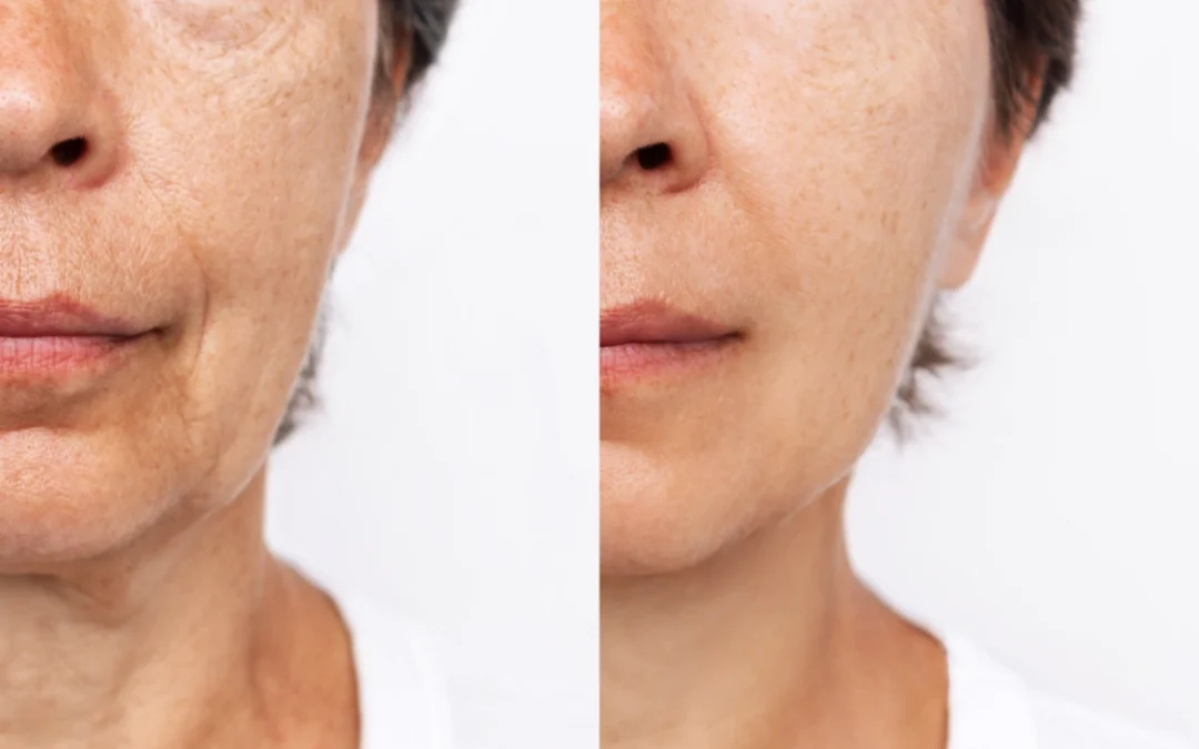 before and after ultraclear before and after ultraclear