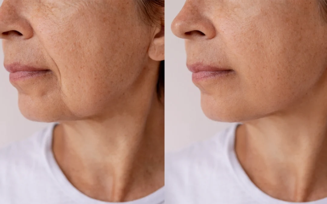 before and after ultraclear before and after ultraclear