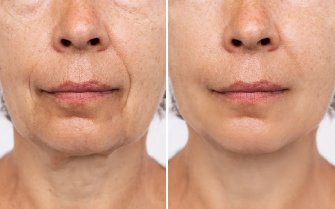 before and after ultraclear before and after ultraclear