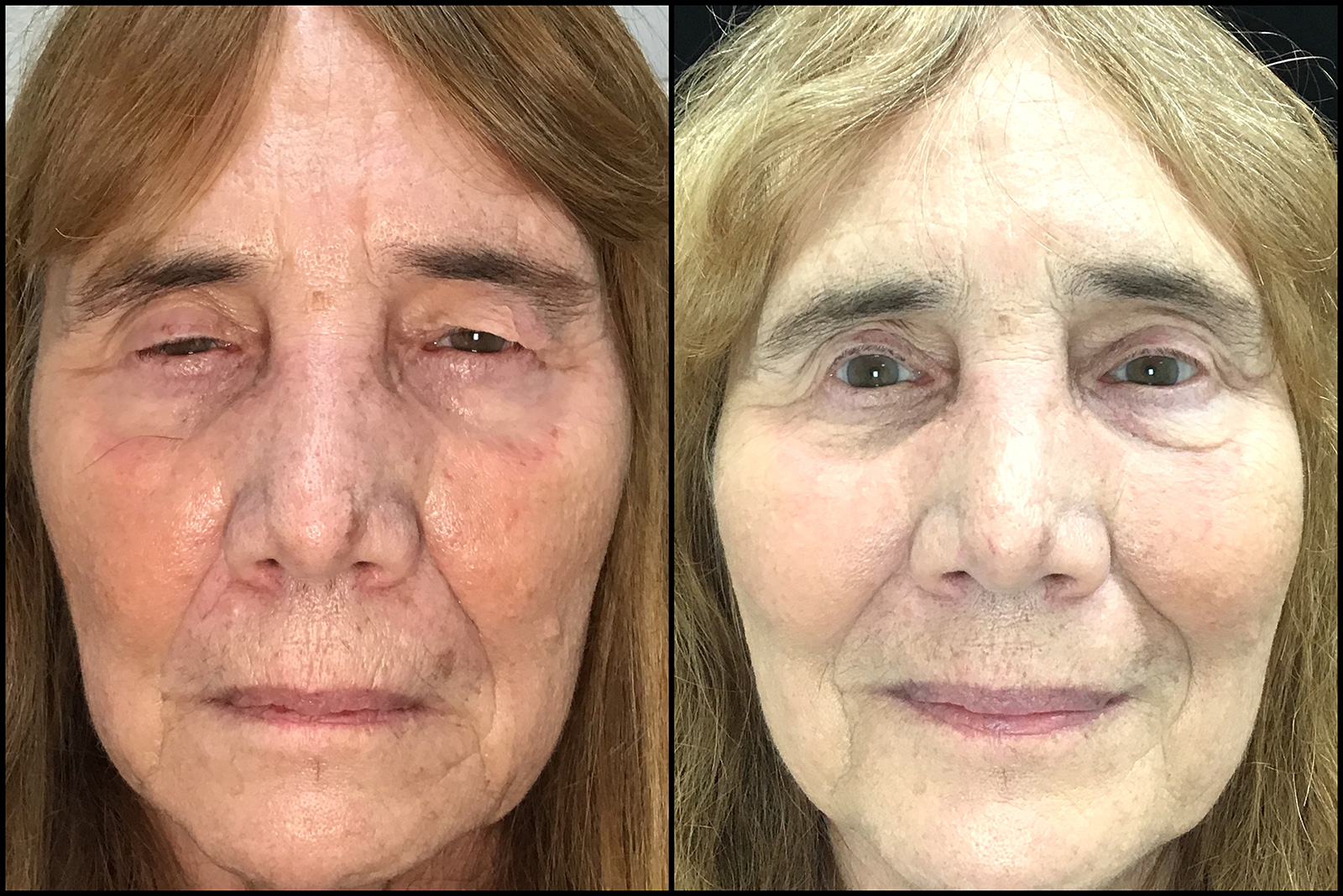Front View Conjunctival Mullerectomy, Upper Blepharoplasty before and after photo by Dr. Tarbet