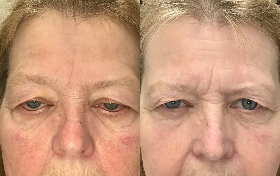 Front View Conjunctival Mullerectomy before and after photo by Dr. Tarbet