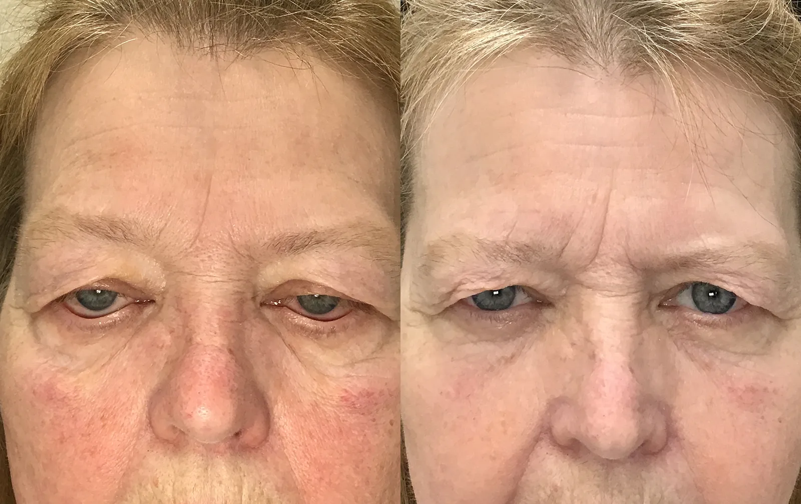 Front View Conjunctival Mullerectomy before and after photo by Dr. Tarbet