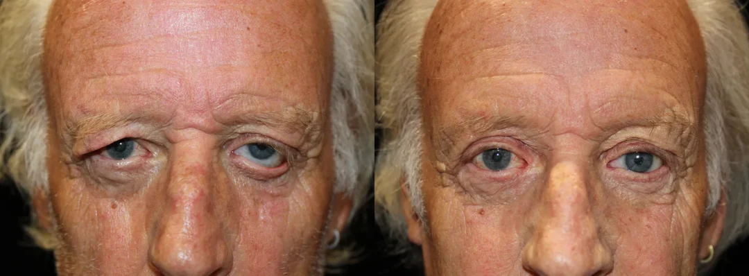 Front View Ectropion Repair Upperlid Blepharoplasty before and after photo by Kristin J Tarbet MD