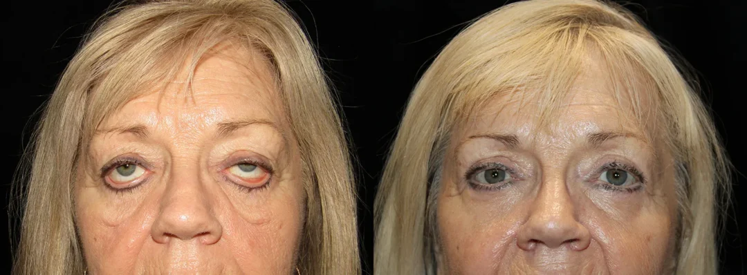 Front View Ectropion Repair Upperlid Blepharoplasty before and after photo by Kristin J Tarbet MD