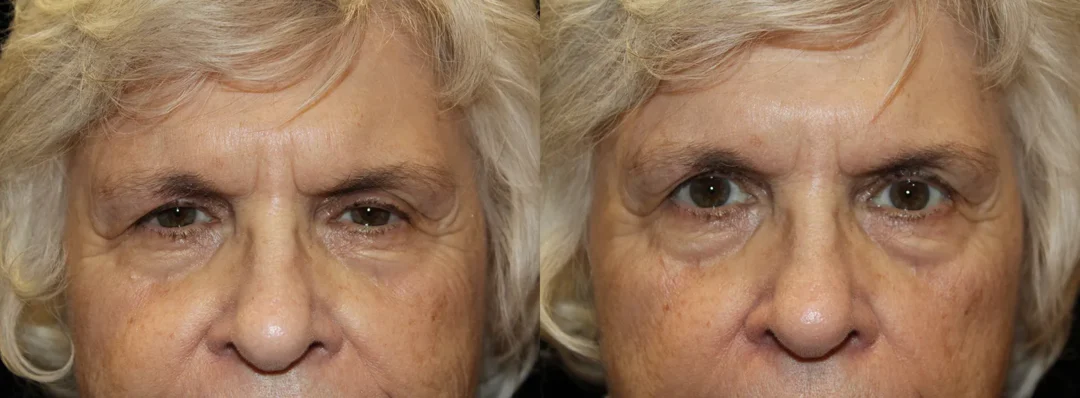 Front View Endoscopic Brow Lift before and after photo by Kristin J Tarbet MD