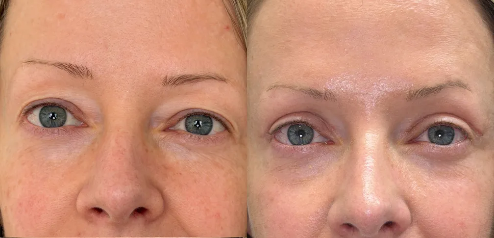 Front View Novathread Browlift & Upper Blepharoplasty before and after photo by Kristin J Tarbet MD