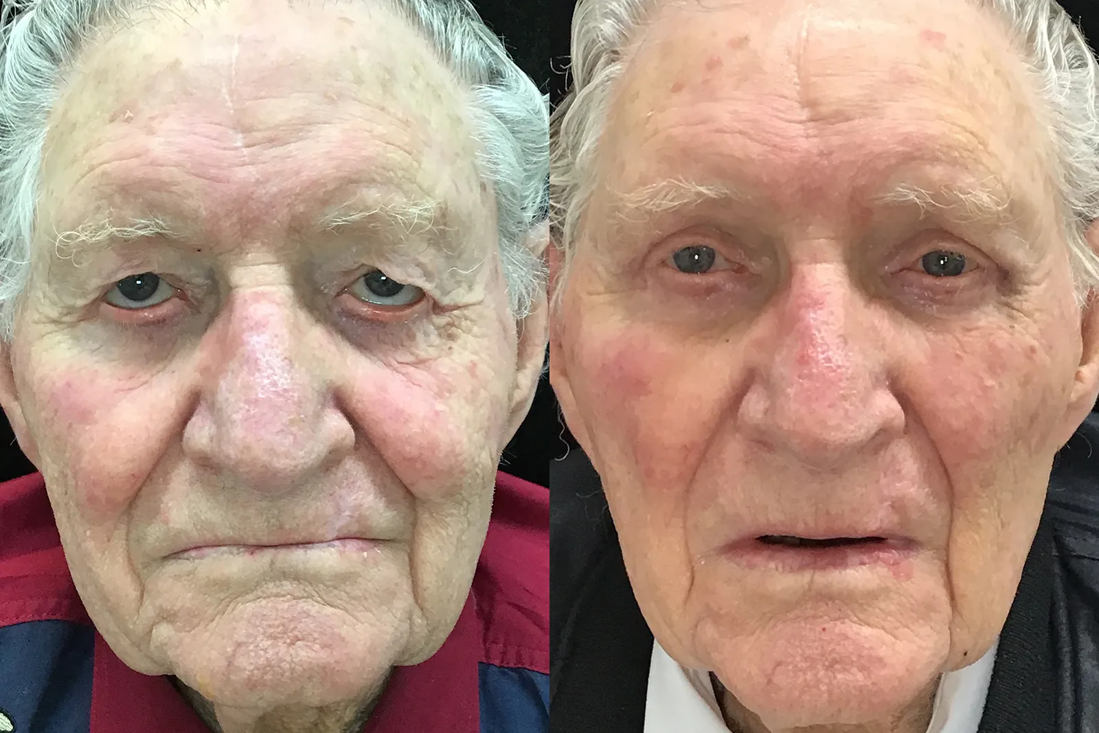 Front View Upper Blepharoplasty, Ectropion Repair before and after photo by Dr. Tarbet