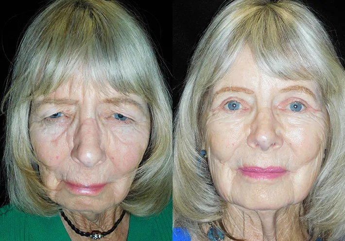 Front View Upper Blepharoplasty before and after photo by Kristin J Tarbet MD