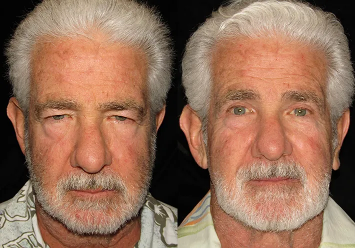 Front View Upper Blepharoplasty before and after photo by Kristin J Tarbet MD