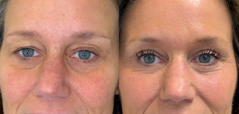 Front View Upper Blepharoplasty with Novathread Browlift before and after photo by Kristin J Tarbet MD