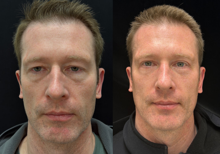 Front View Upper & Lower Blepharoplasty before and after photo by Kristin J Tarbet MD