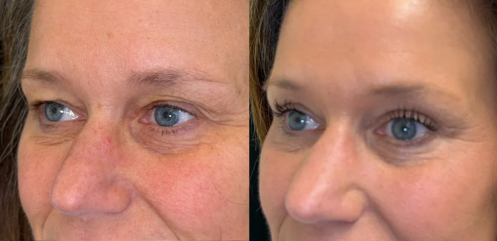 Left Oblique View Upper Blepharoplasty with Novathread Browlift before and after photo by Kristin J Tarbet MD