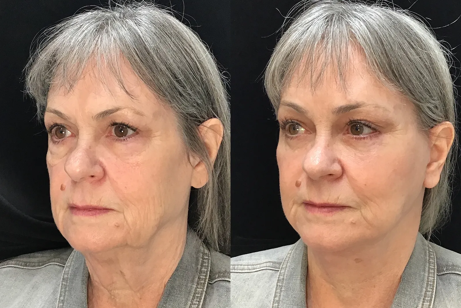 Oblique View Facelift, Neck Liposuction, Endoscopic browlift before and after photo by Dr. Tarbet