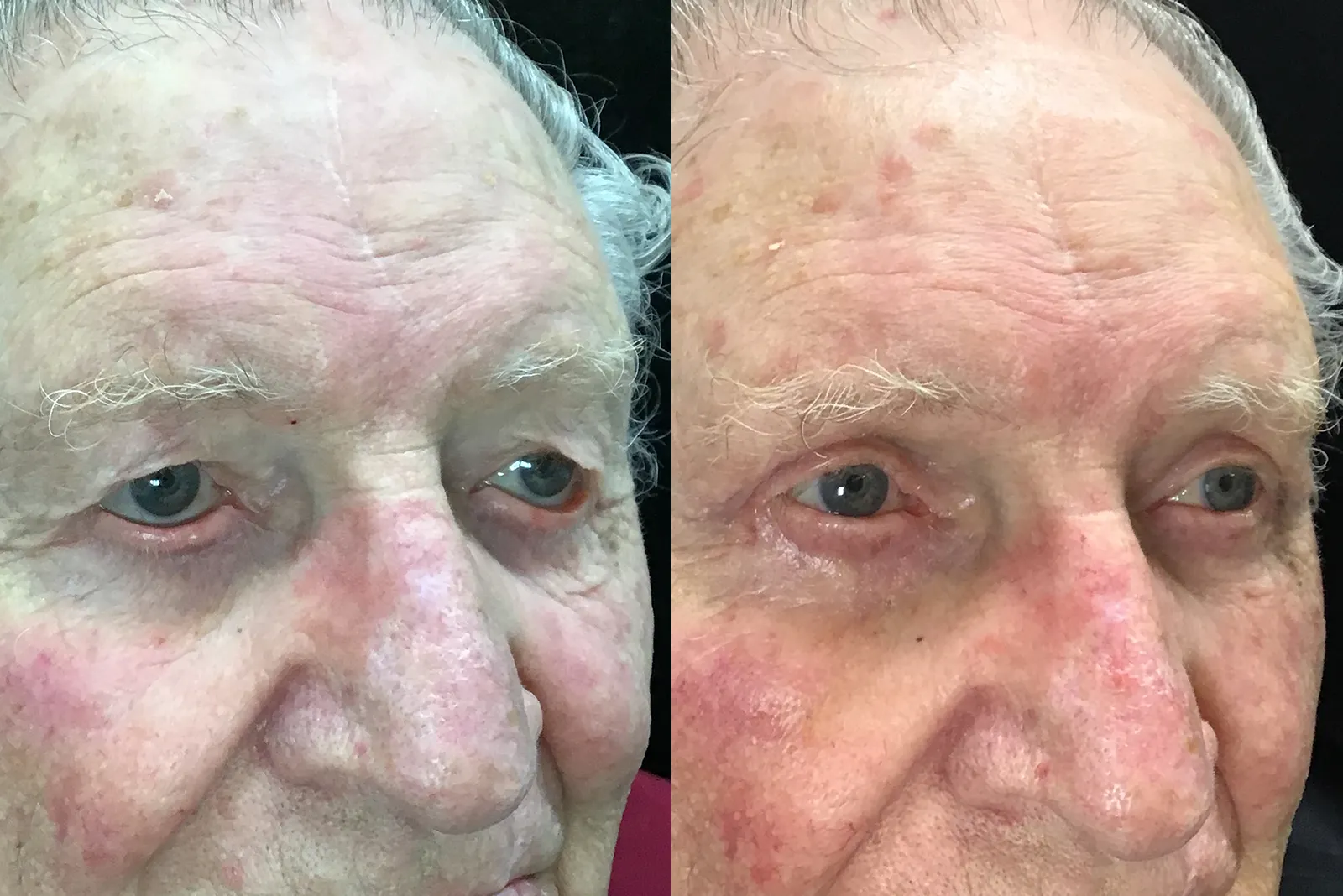 Oblique View Upper Blepharoplasty, Ectropion Repair before and after photo by Dr. Tarbet