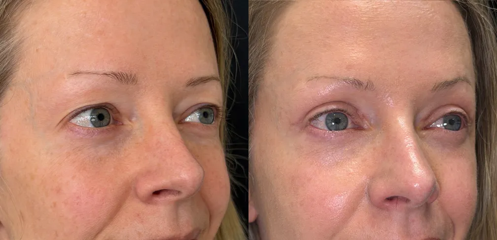 Right Oblique View Novathread Browlift & Upper Blepharoplasty before and after photo by Kristin J Tarbet MD