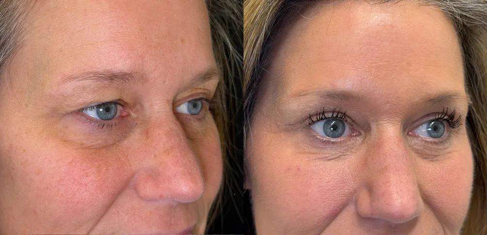 Right Oblique View Upper Blepharoplasty with Novathread Browlift before and after photo by Kristin J Tarbet MD