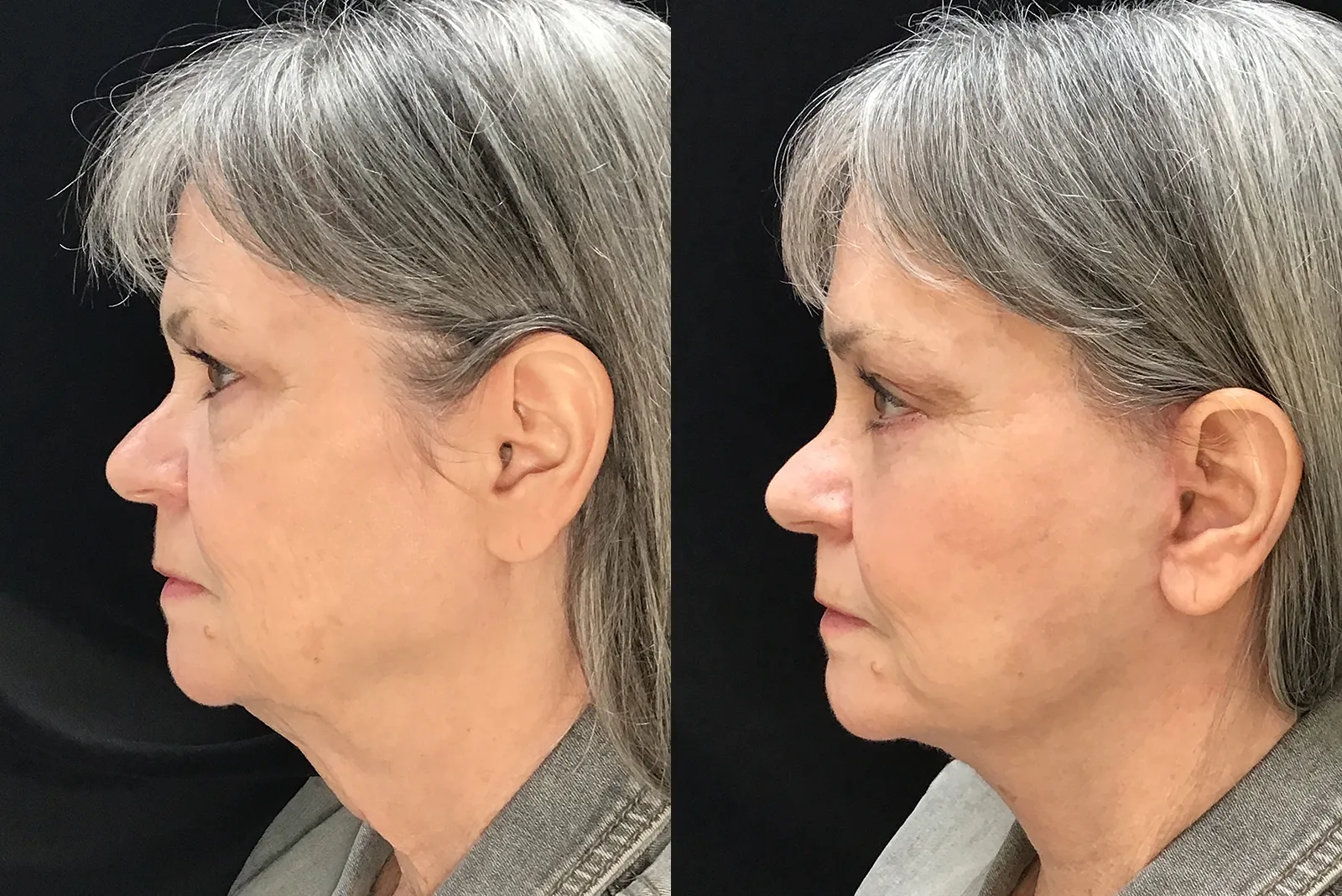 Side View Facelift, Neck Liposuction, Endoscopic browlift before and after photo by Dr. Tarbet