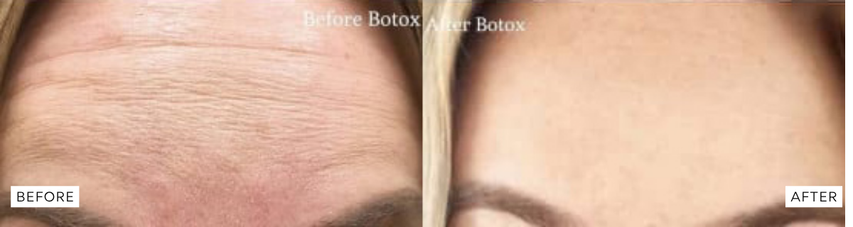 botox before and after results botox before and after results