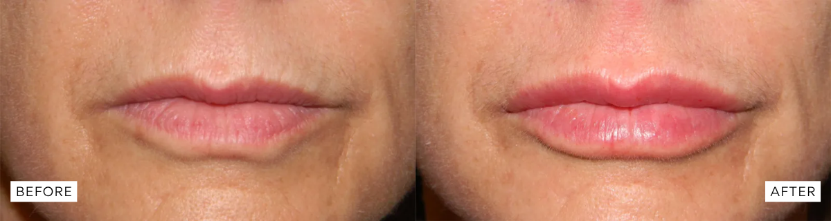 lip filler before and after results lip filler before and after results