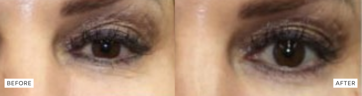 prp before and after results prp before and after results