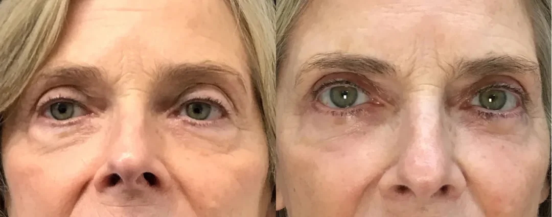 Close Up View Lower Blepharoplasty before and after photo by Dr. Tarbet