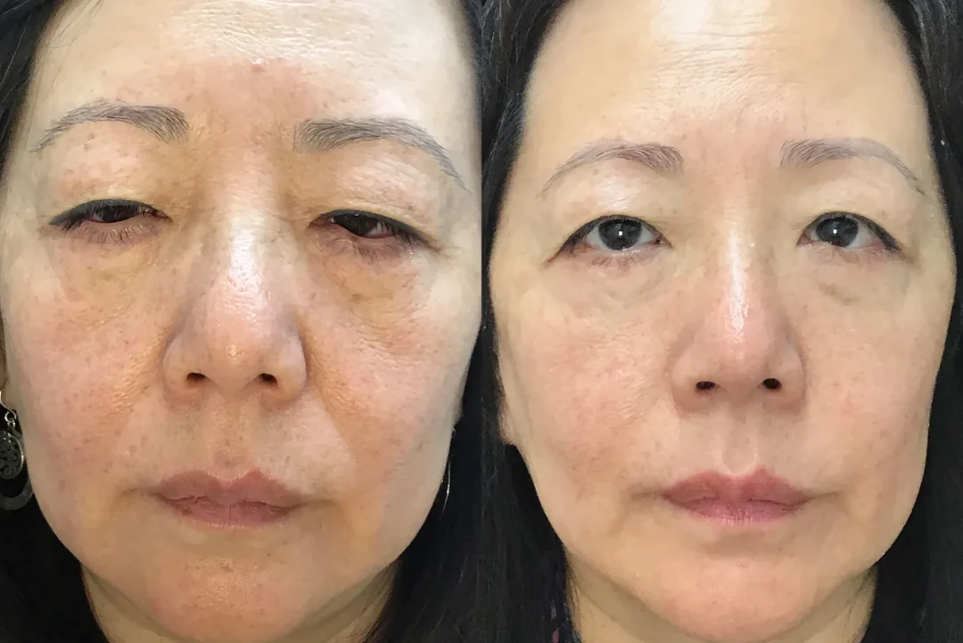 Front View Conjunctival Myomectomy, Ectropion Repair, Lower Blepharoplasty before and after photo by Dr. Tarbet