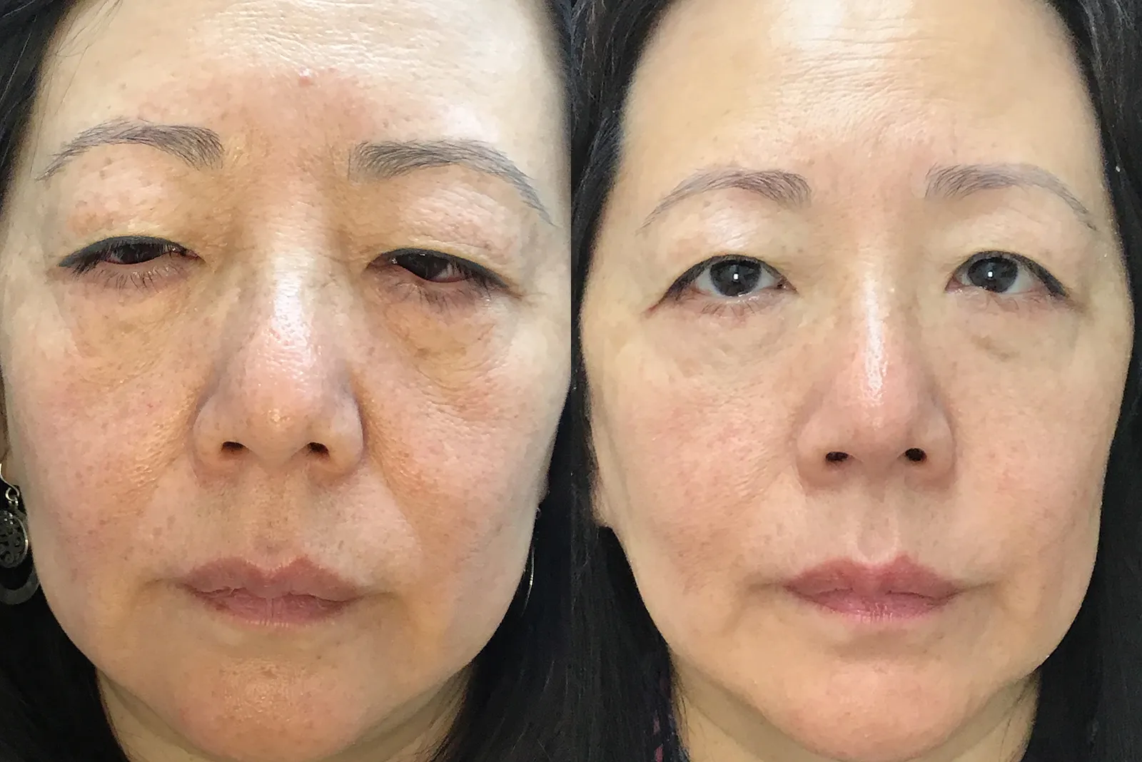 Front View Conjunctival Myomectomy, Ectropion Repair, Lower Blepharoplasty before and after photo by Dr. Tarbet