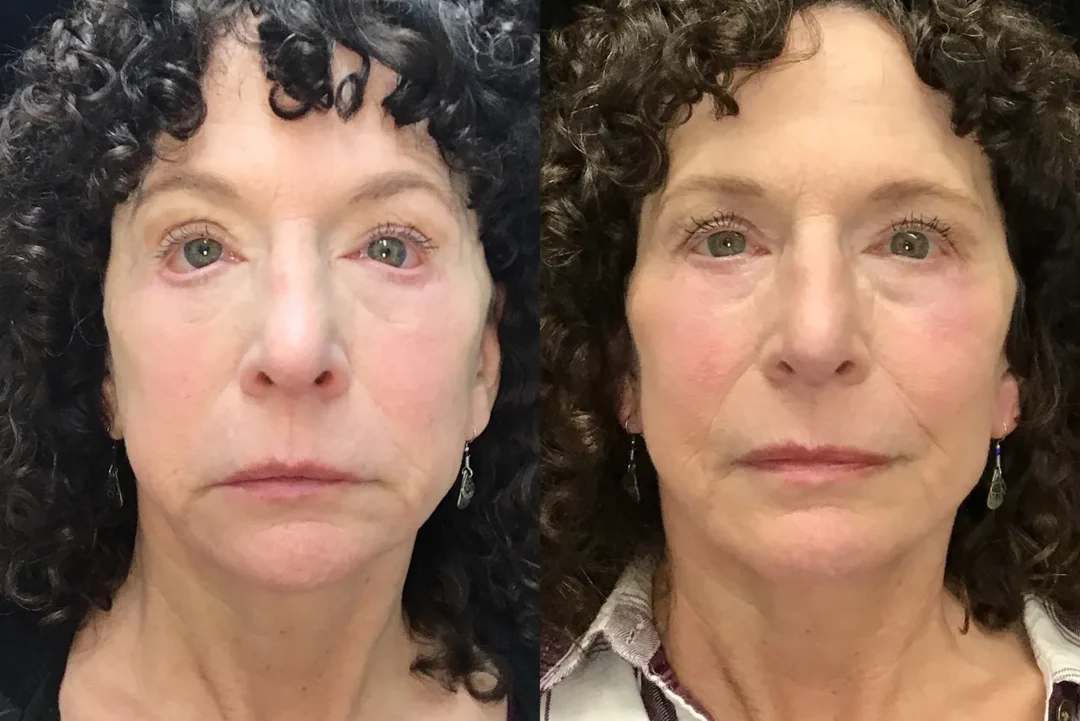 Front View Conjunctivoplasty, Ectropion repair before and after photo by Dr. Tarbet