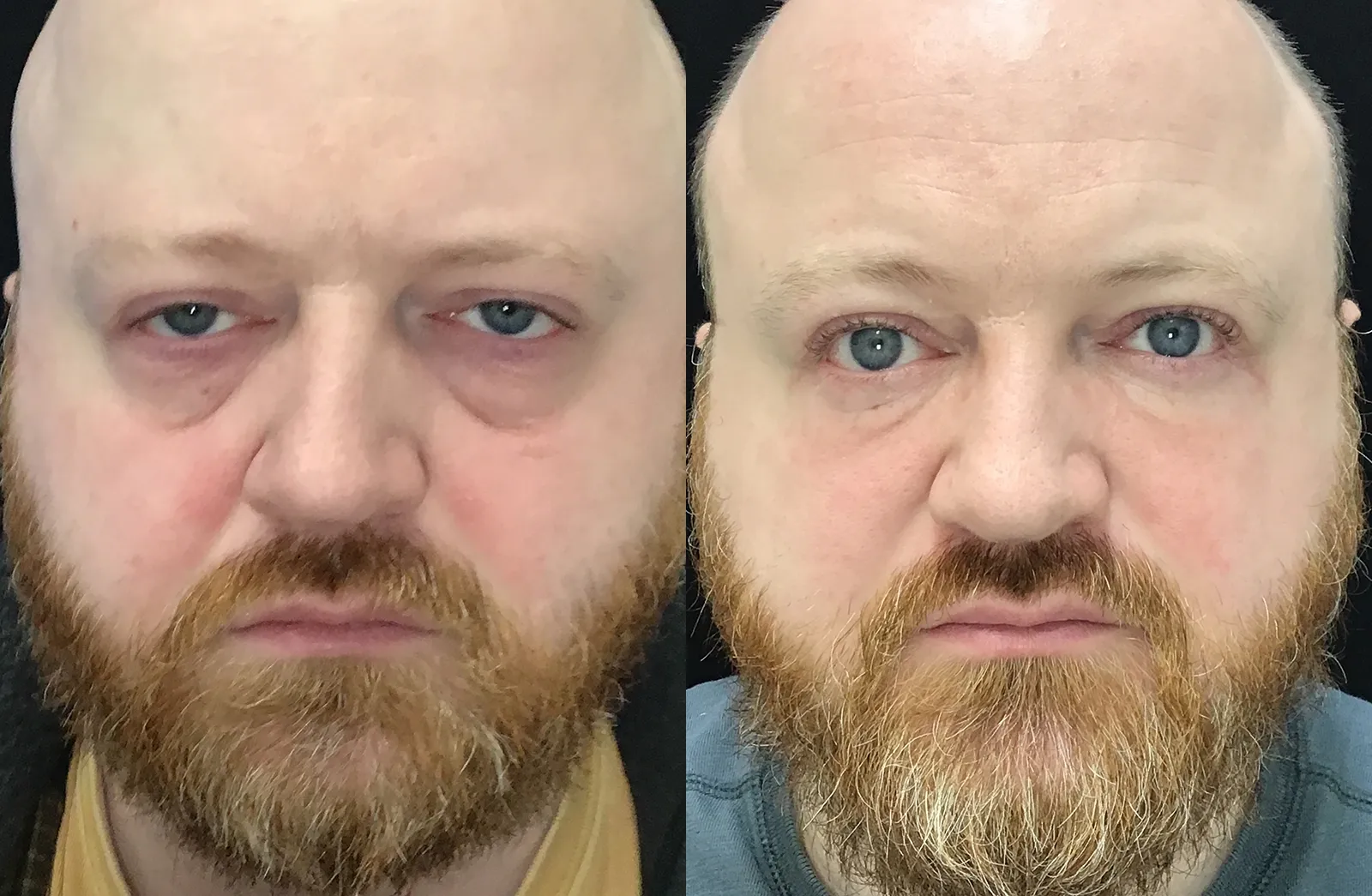 Front View Ectropion Repair, Lower Blepharoplasty, Cheeklift before and after photo by Dr. Tarbet