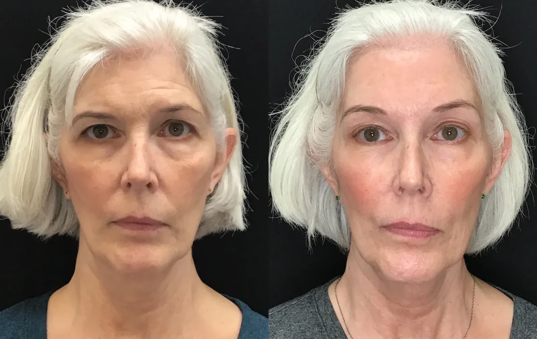 Front View Endoscopic Browlift before and after photo by Dr. Tarbet