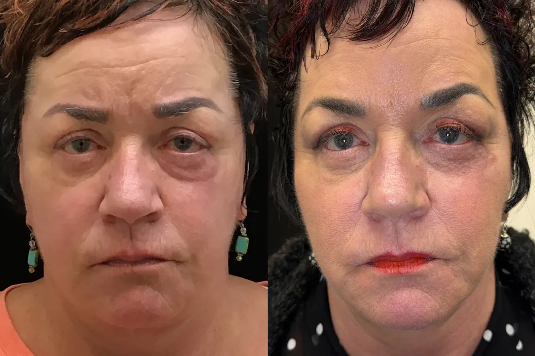 Front View Facelift, Neck Liposuction, Quad Blepharoplasty, Cheeklift, Ectropion Repair before and after photo by Dr. Tarbet