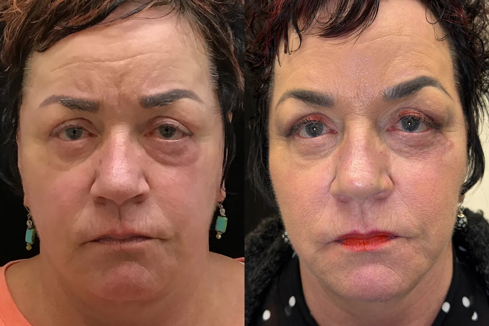 Front View Facelift, Neck Liposuction, Quad Blepharoplasty, Cheeklift, Ectropion Repair before and after photo by Dr. Tarbet