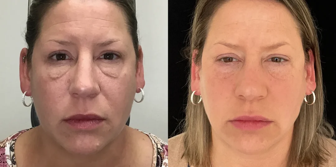 Front View Lower Blepharoplasty before and after photo by Dr. Tarbet