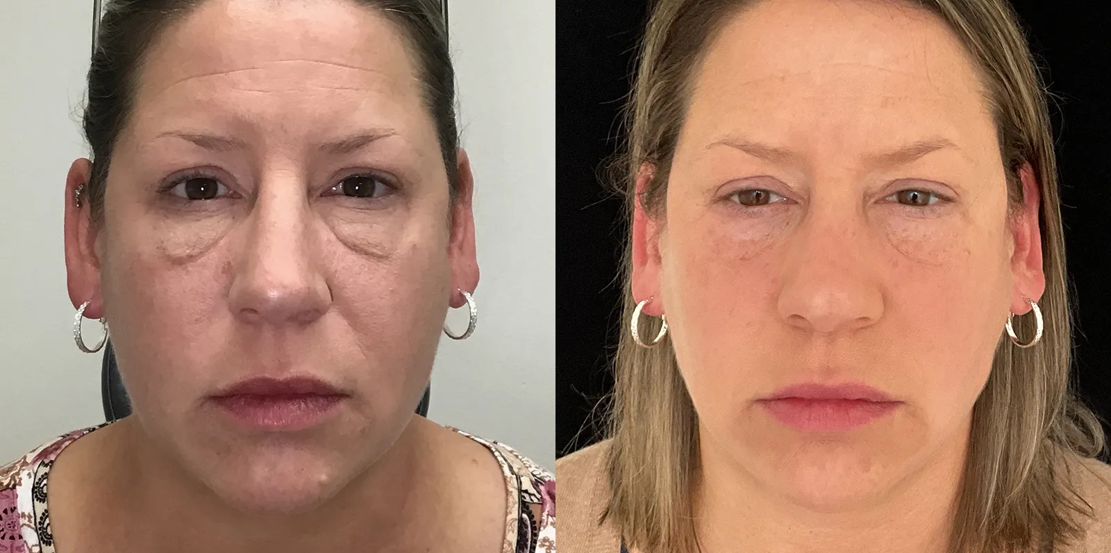 Front View Lower Blepharoplasty before and after photo by Dr. Tarbet