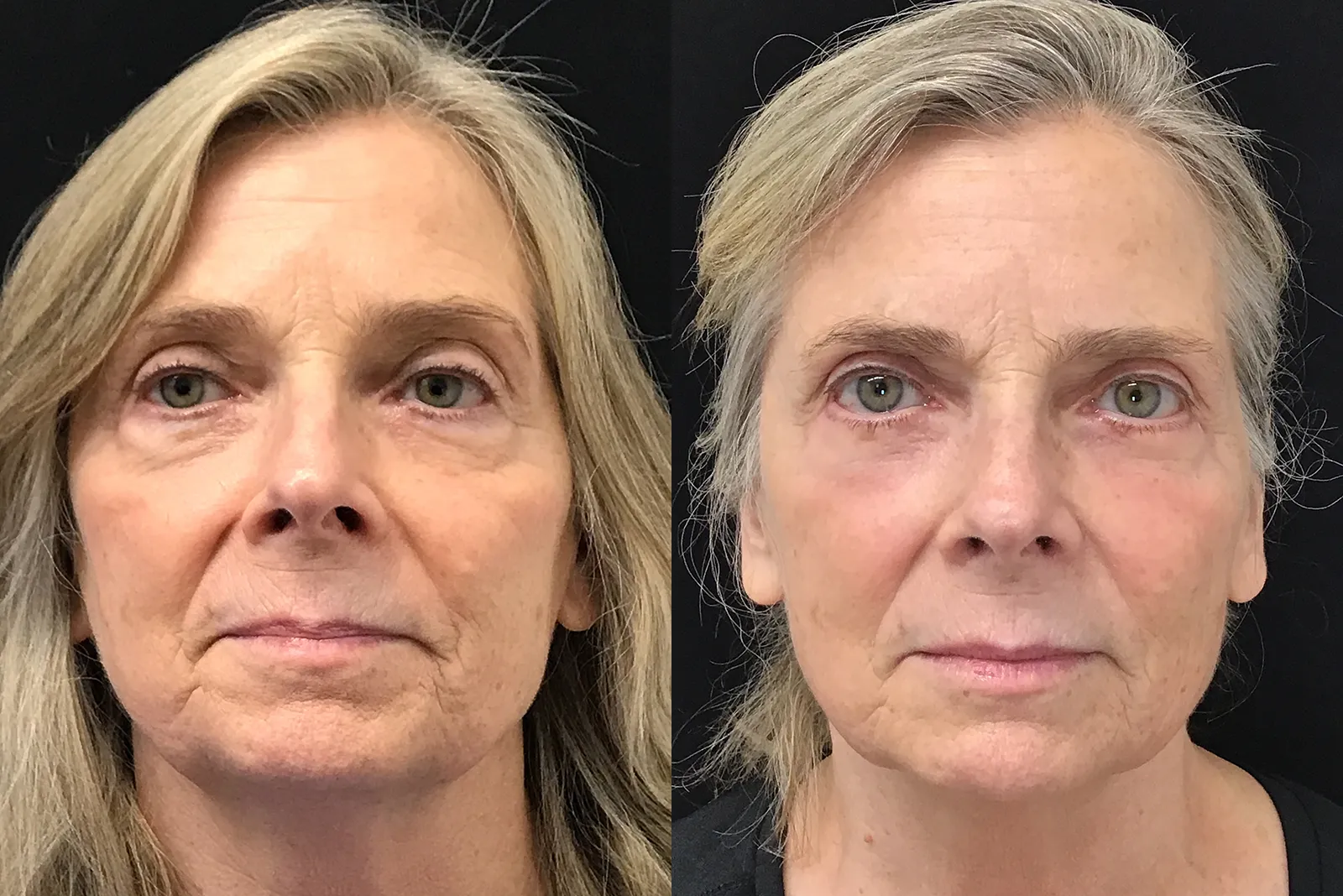 Front View Lower Blepharoplasty before and after photo by Dr. Tarbet